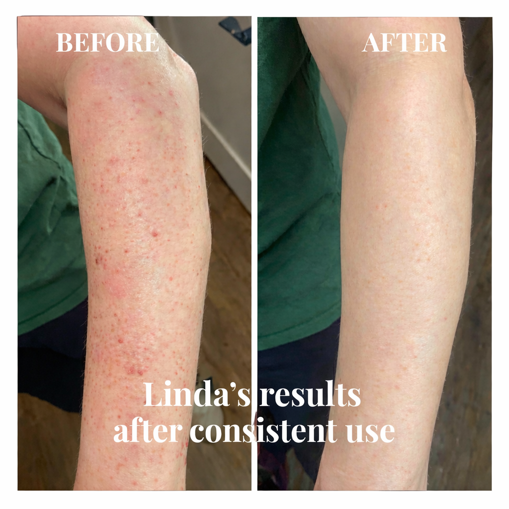 PURE515 - 10% Tranexamic Acid Serum - Fade Dark Spots Fast